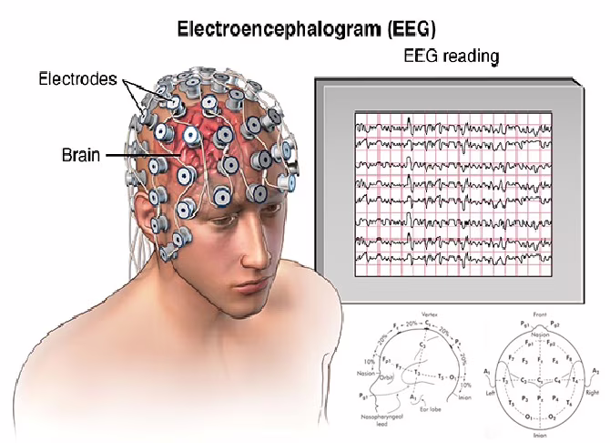 Mild Cognitive Impairment, EEG 10-20 System