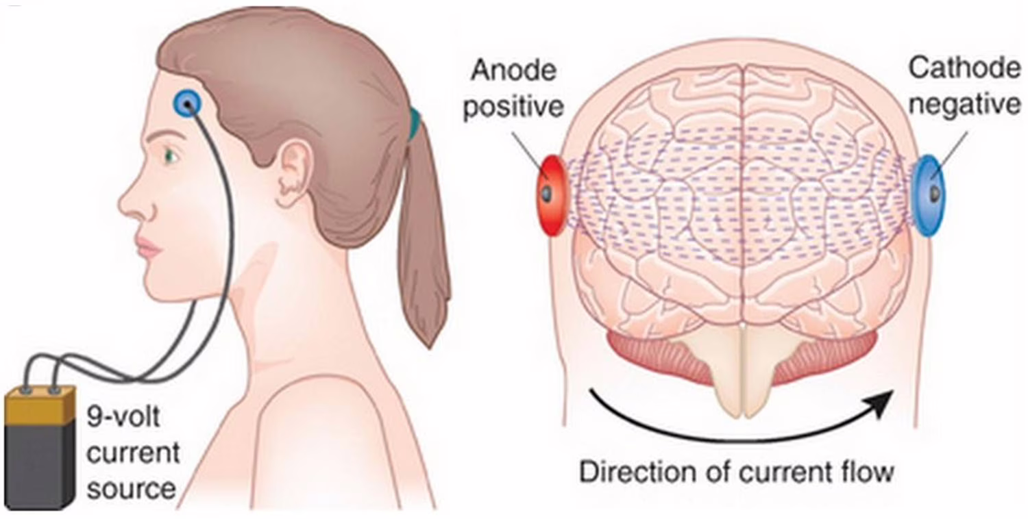 tDCS 