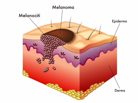Diversi strati della pelle con esempio di melanoma