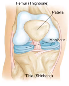 Il menisco, posto tra il femore e la tibia