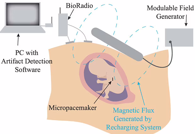 Sistema di ricarica wireless per il pacemaker fetale