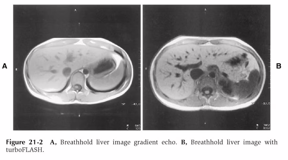 paragone dell'acquisizione in apnea del fegato, (A) immagine gradient echo (B) immagine con TurboFlash
