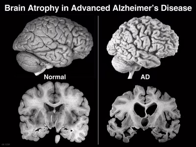 scansioni di confronto tra un cervello sano e uno affetto dal morbo di Alzheimer