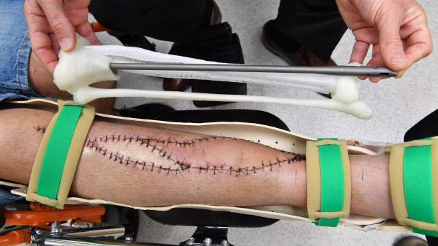 Replica della tibia stampata in 3D utilizzata nell'intervento