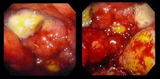 Linfoma gastrico