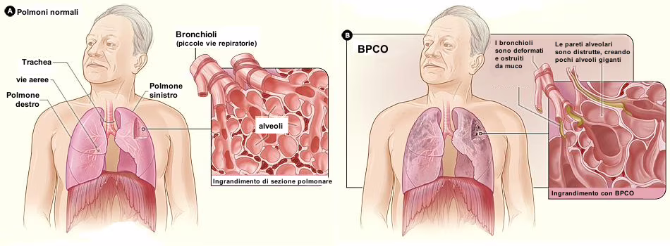differenza tra polmoni sani e polmoni malati di Broncopneumopatia Cronica Ostruttiva