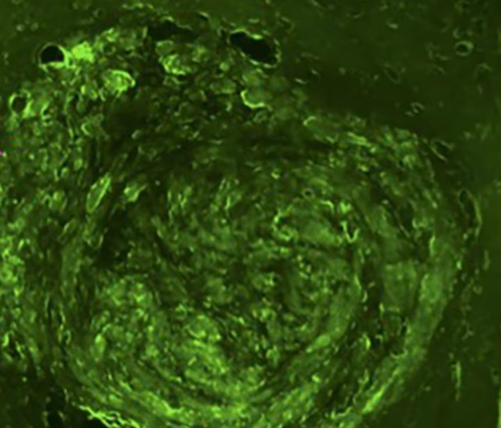 ultrasuoni focalizzati per biopsia liquida cerebrale