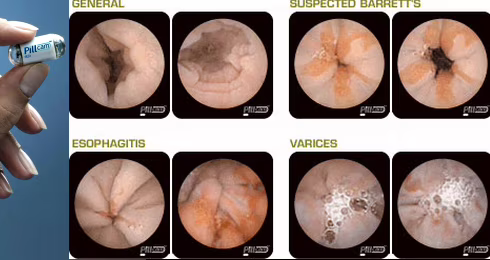 Ravenna: niente più colonscopia, arriva la videocapsula che filma l'intestino