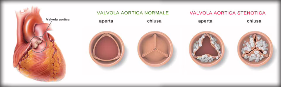 Stenosi aortica