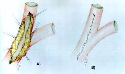 Esempio sutura chirurgica