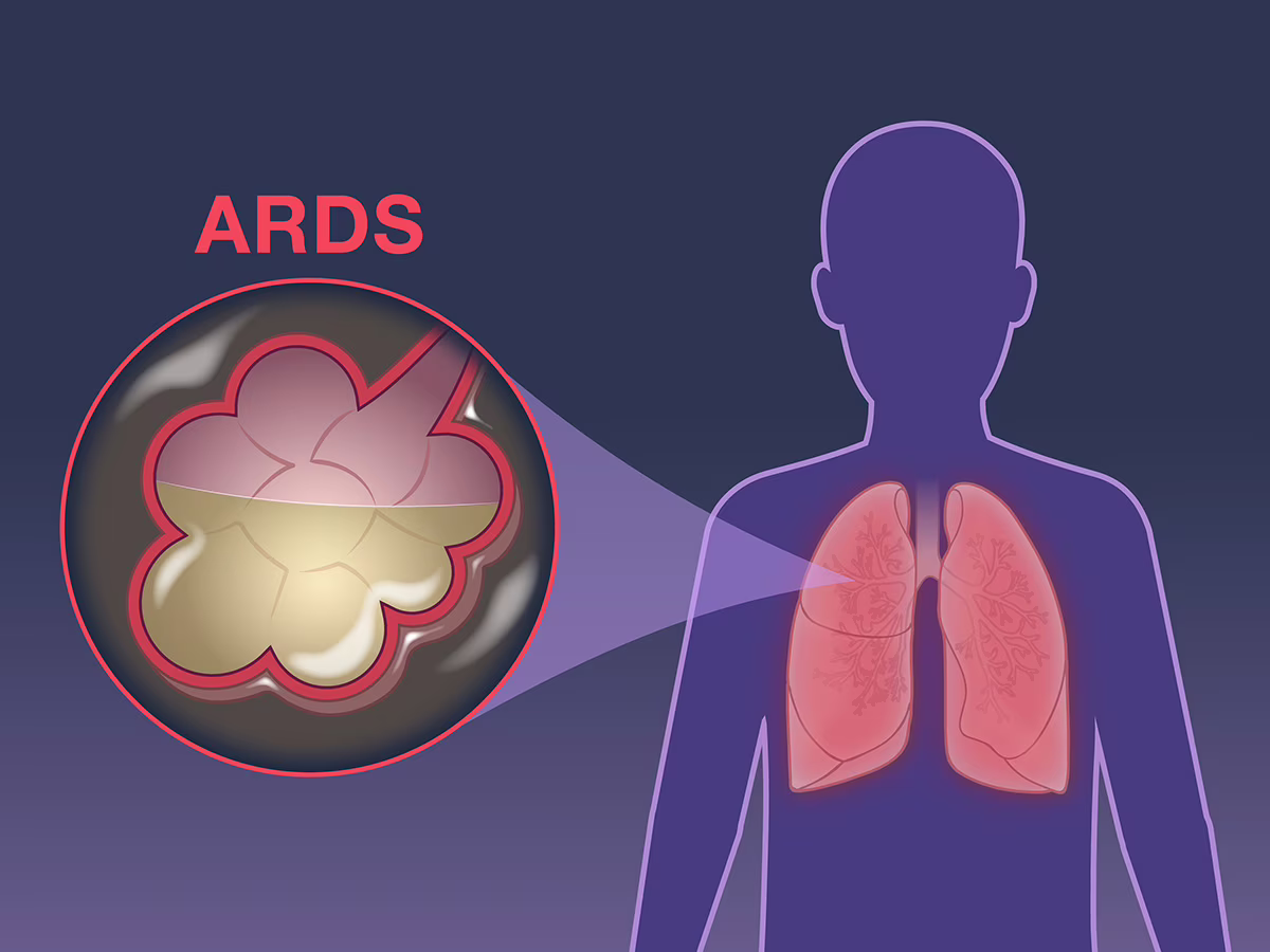 ards sindrome distress respiratorio polmoni