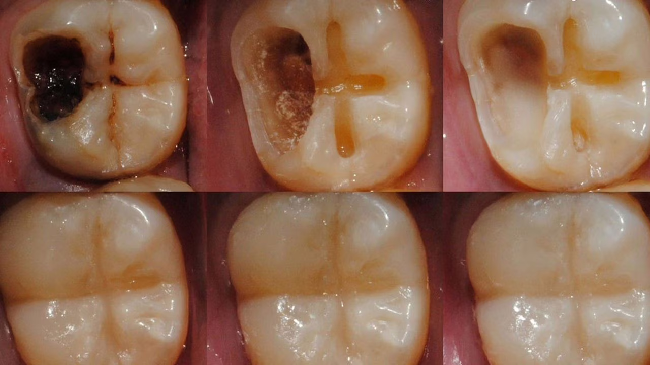 smalto gel rigenerativa denti cinesi università 