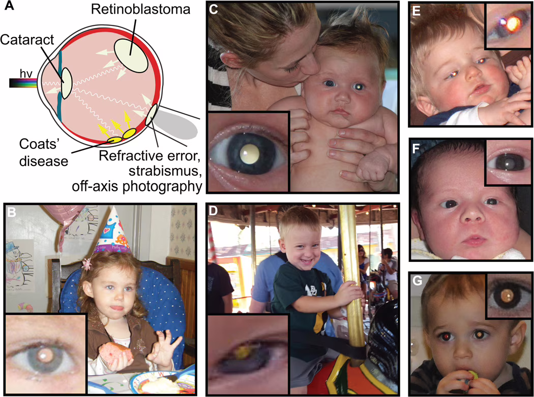 cradle app occhio malattia bambini leucocoria
