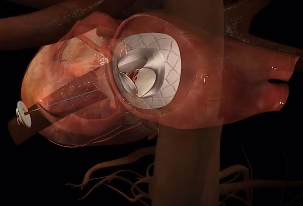 Prima valvola mitrale transcatetere approvata in Europa. Credits: dicardiology.com