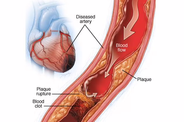 cellule staminali pluripotenti indotte cuore cardiopatia ischemica trapianti
