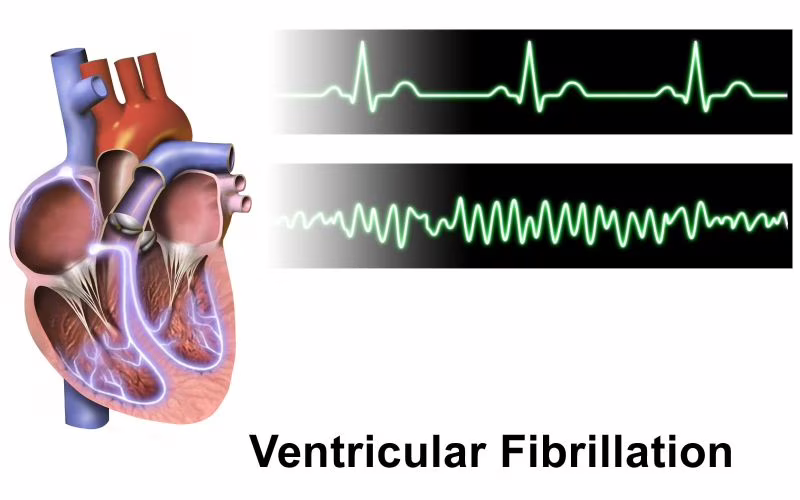 defibrillatore indossabile morte cardiaca improvvisa