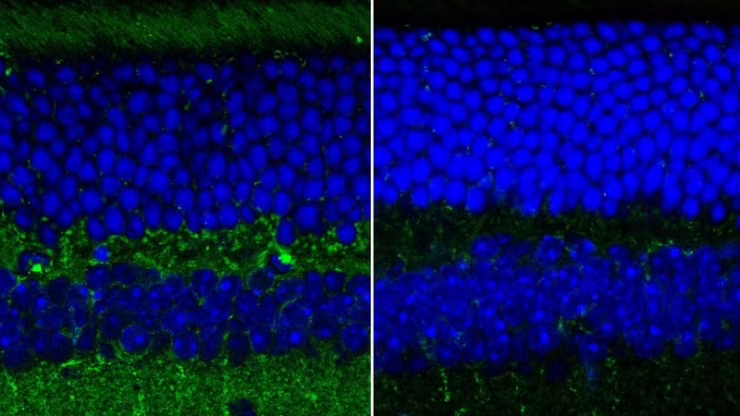 Biomarcatori retinici per la diagnosi precoce della malattia di Alzheimer. Credits: Scientific Reports