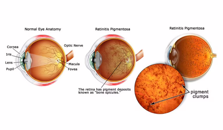 retina artificiale liquida IIT italia retinite pigmentosa credits: irisvision.com