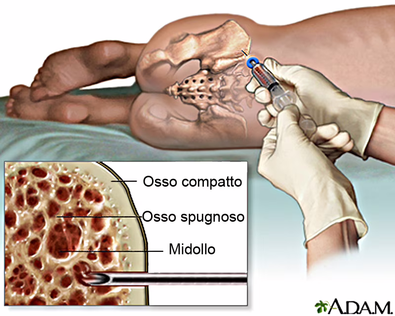 covid bambino trapianto midollo plasma terapia