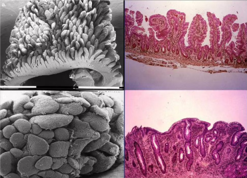 Il glutine fa male solo ai celiaci e la celiachia è una malattia. Credits: Green PH, Cellier C. Celiac disease.