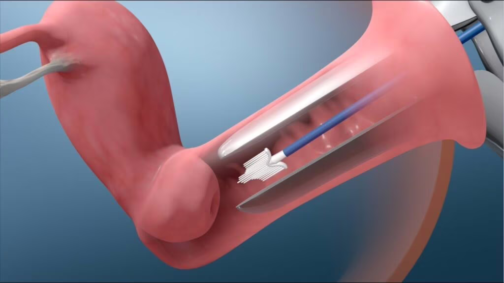 Tumore dell'ovaio pap test diagnosi 6 anni prima