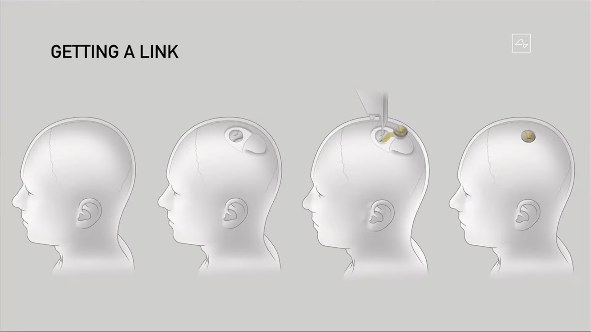 Elon Musk ha presentato i progressi del chip rivoluzionario di Neuralink. Credits: Neuralink