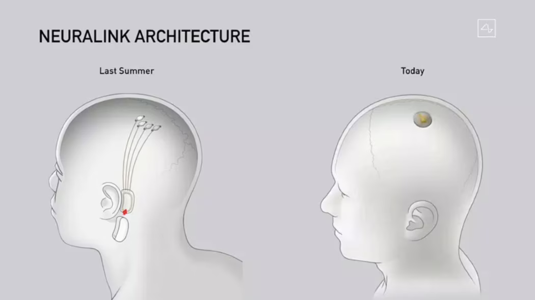 Elon Musk ha presentato i progressi del chip rivoluzionario di Neuralink. Credits: Neuralink