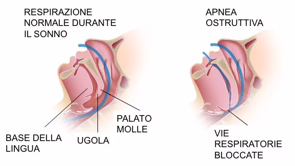 Respirazione normale e in caso di apnea notturna