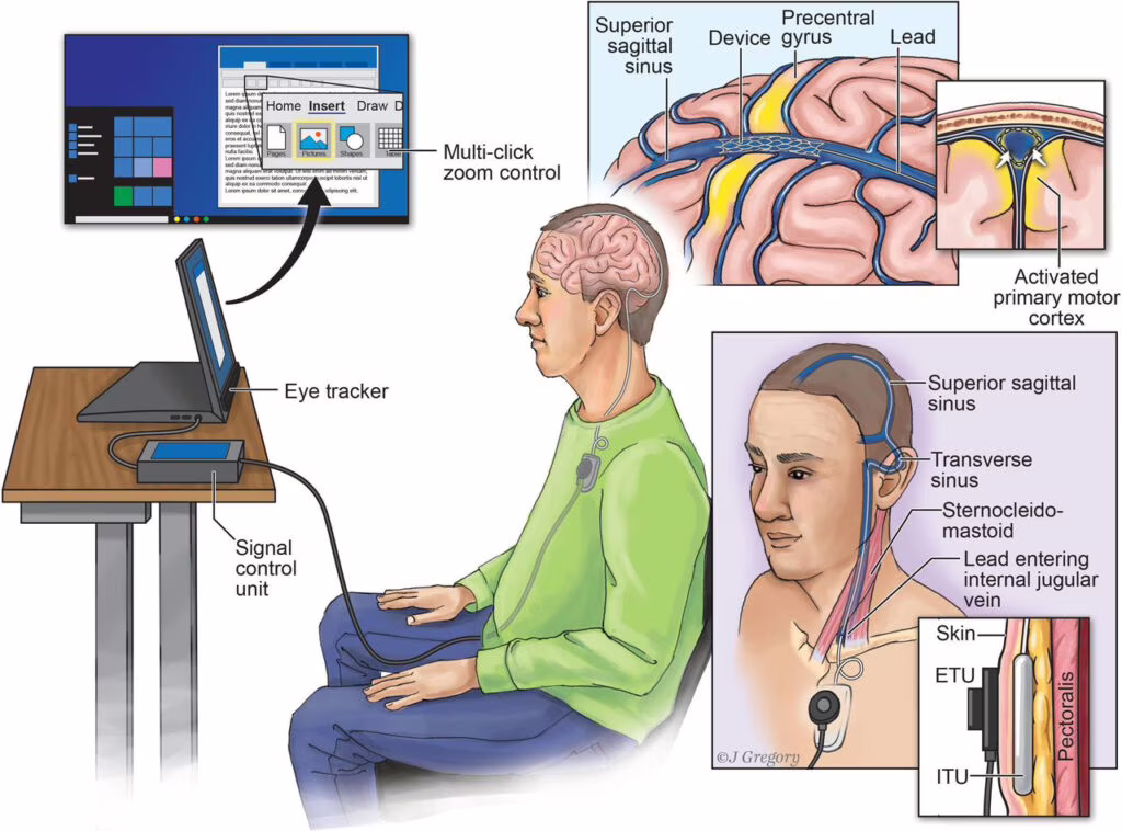 È stata impiantata nell'uomo la prima interfaccia neurale endovascolare. Credits: Synchron