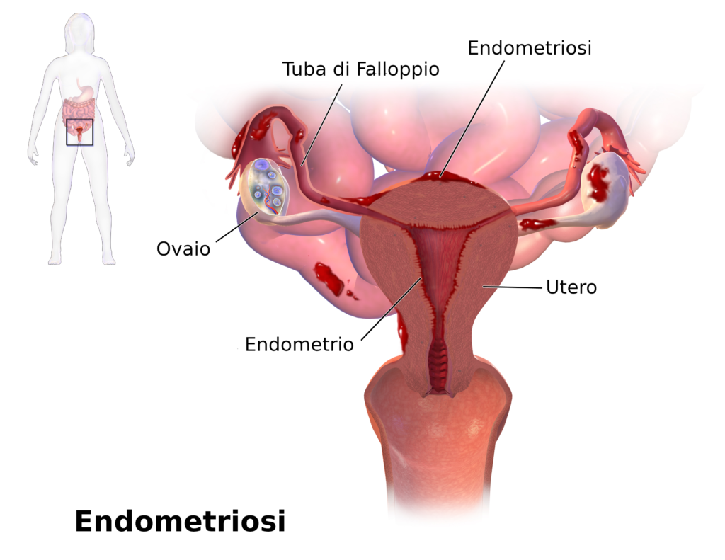 Cos’è l’endometriosi e come si cura?