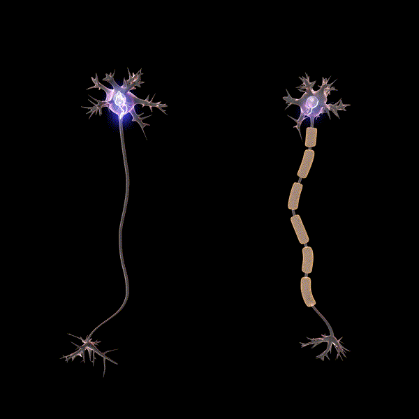 Sclerosi multipla, svolta nella ricerca: le cellule che producono mielina sono sane ma bloccate dall’infiammazione. Credits: Dr. Jana