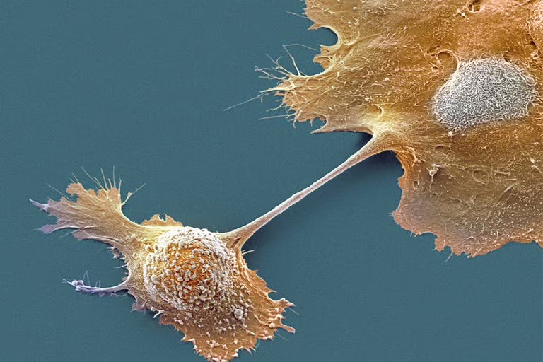 Tumore del pancreas: nuova strategia con vaccino e chemioterapia. Credits: Steve Gschmeissner / Science Photo Library