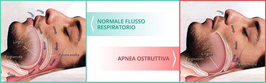 apnea notturna