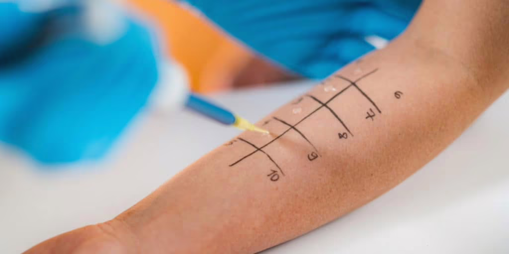 Prick Test allergie
