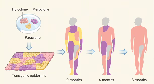 epidermolisi bollosa