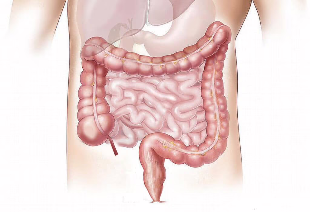 diverticolite del colon