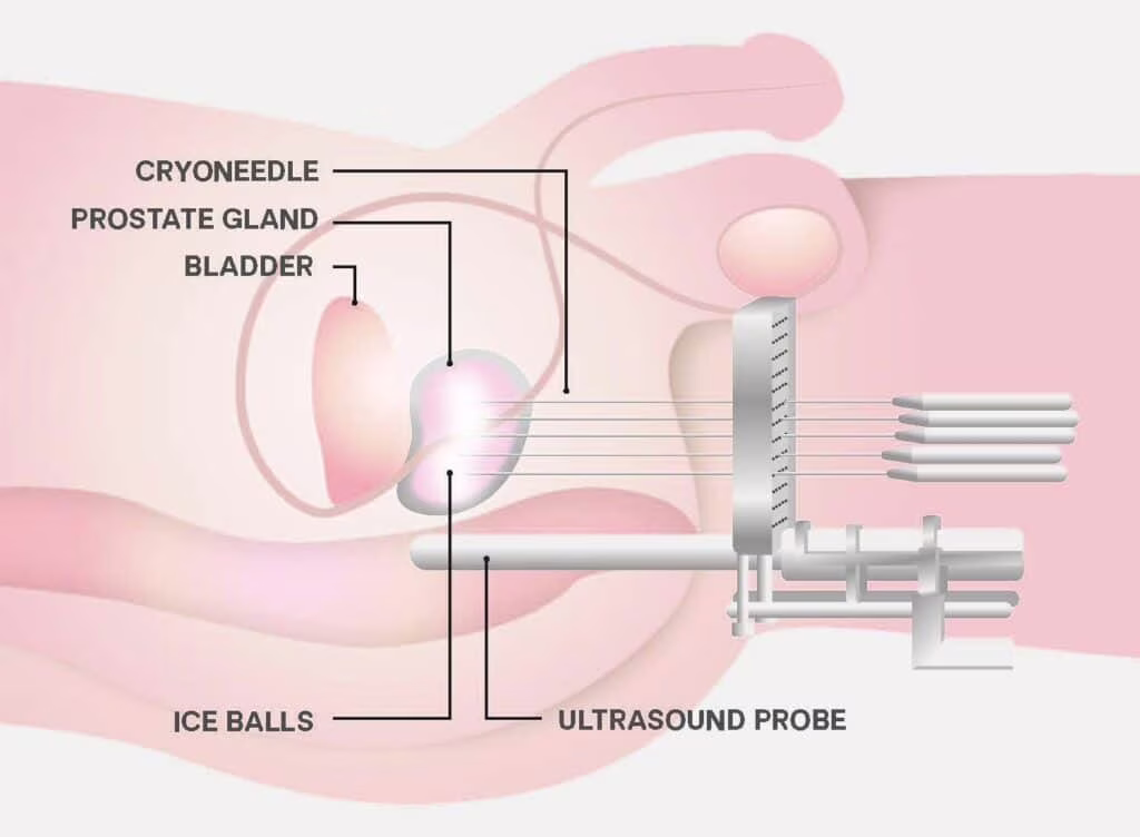 Tumore della prostata: innovazione tecnologica e nuova pratica clinica