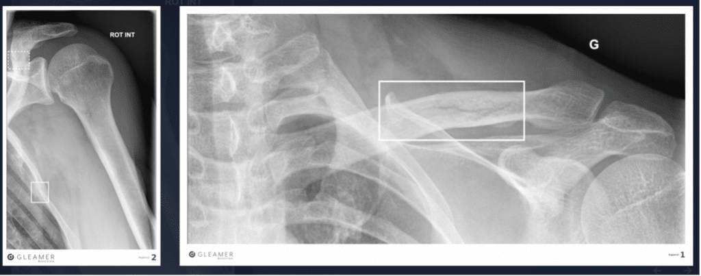 BoneView: il software che diagnostica le fratture