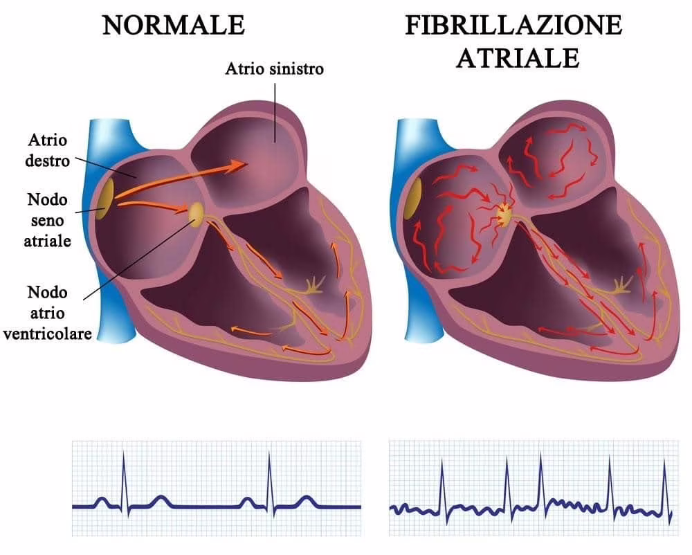 KardiaMobile: come rilevare la fibrillazione atriale attraverso lo smartphone