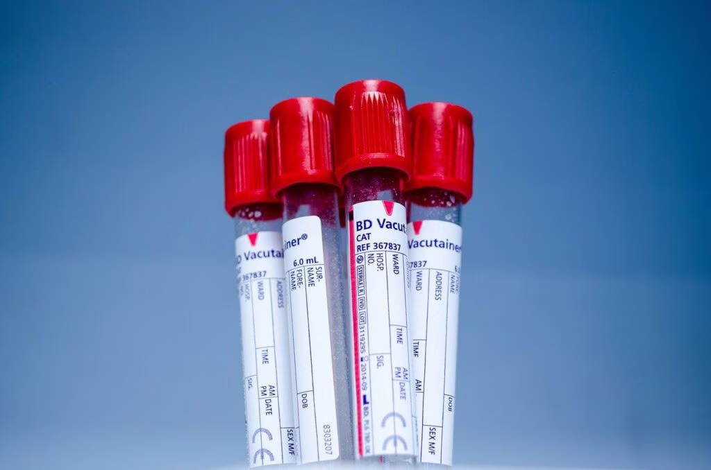Nuovi test per diagnosticare l'Alzheimer in anticipo