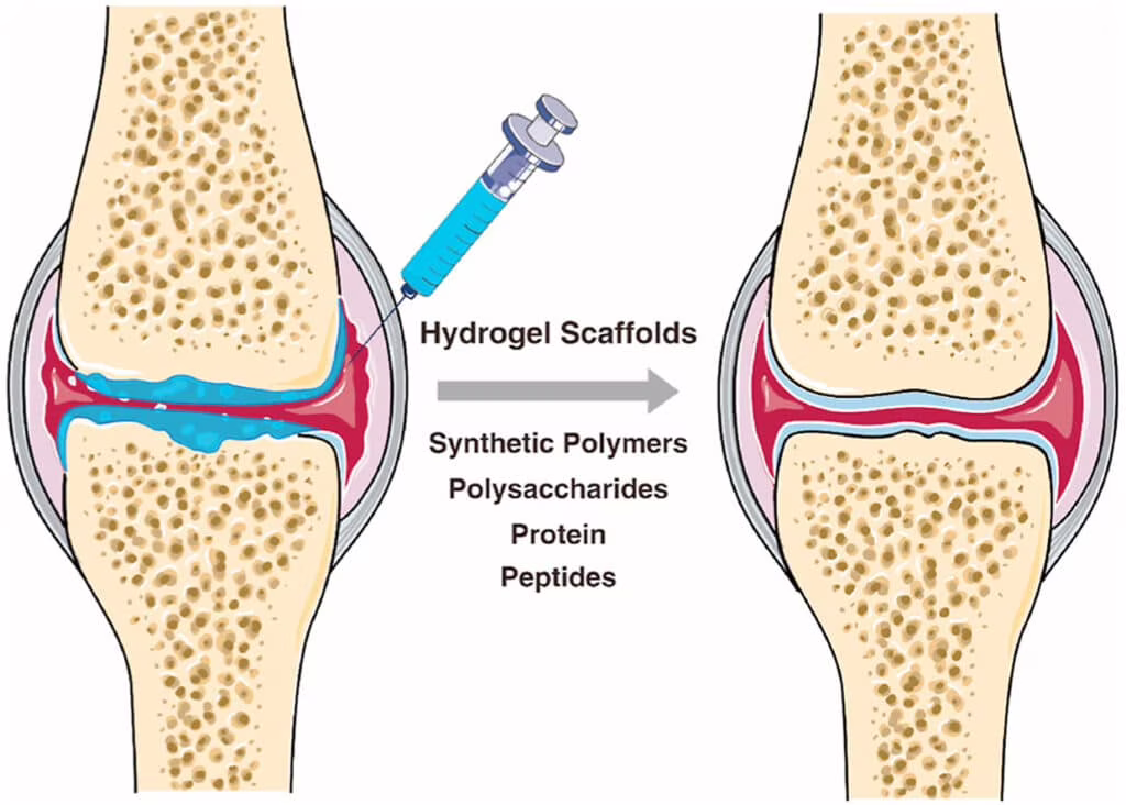 Hydrogel osteoartrite 