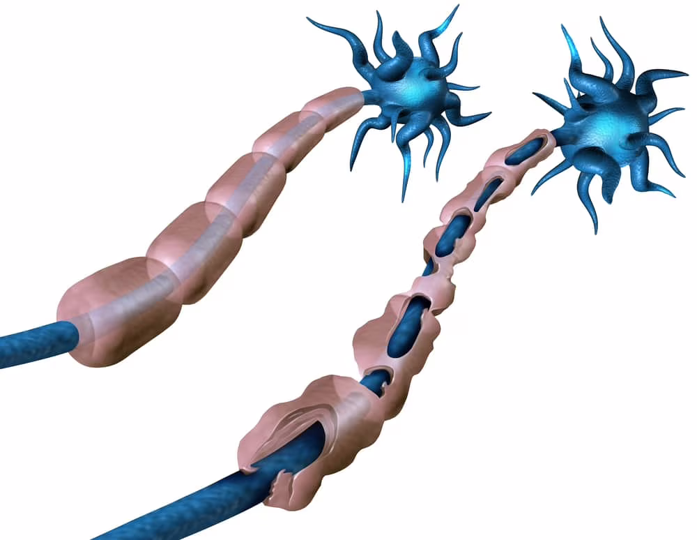  PoNS™: il primo dispositivo di stimolazione elettrica per la sclerosi multipla