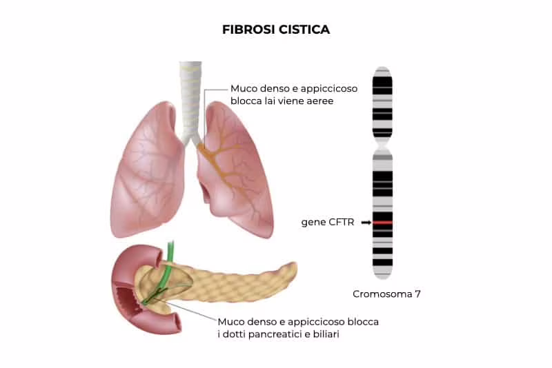 Fibrosi Cistica: l’importanza del corretto funzionamento del canale CFTR