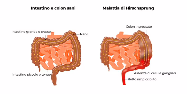 Intestino sano ed intestino con malattia di Hirschsprung a confronto