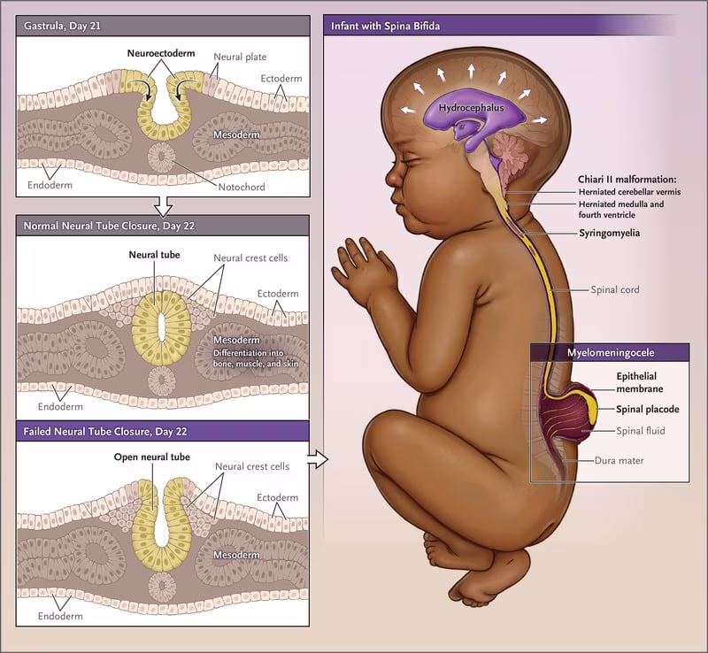 spina bifida