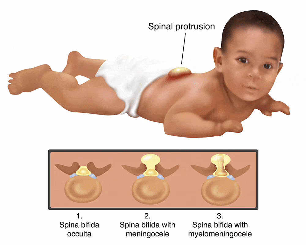 spina bifida