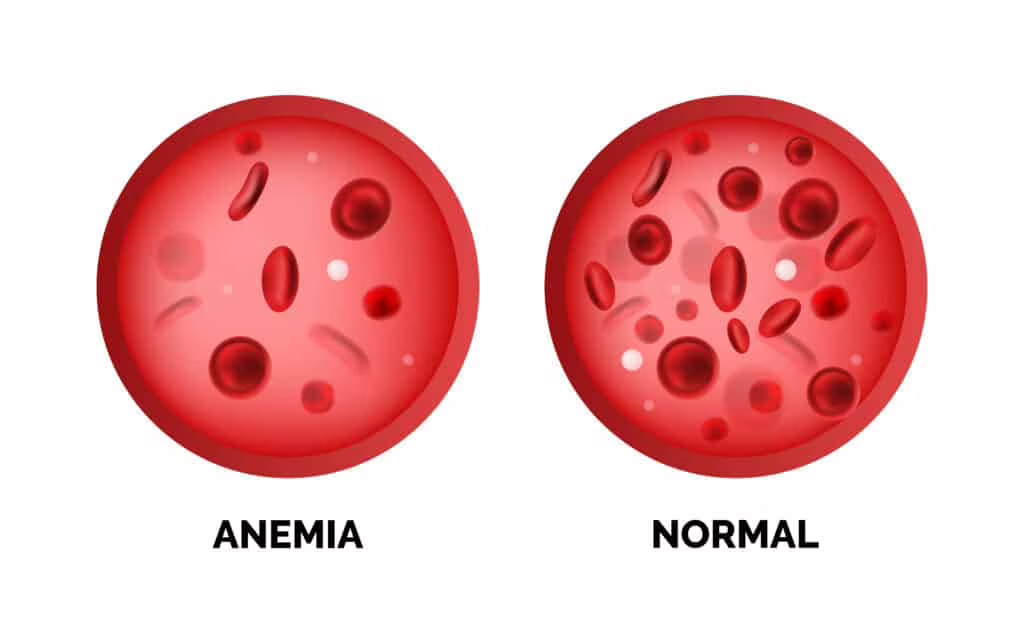 leucemia