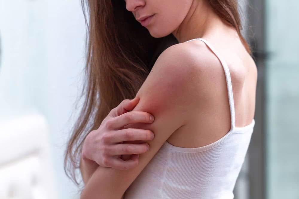 Dermatite atopica Lupus eritematoso sistemico