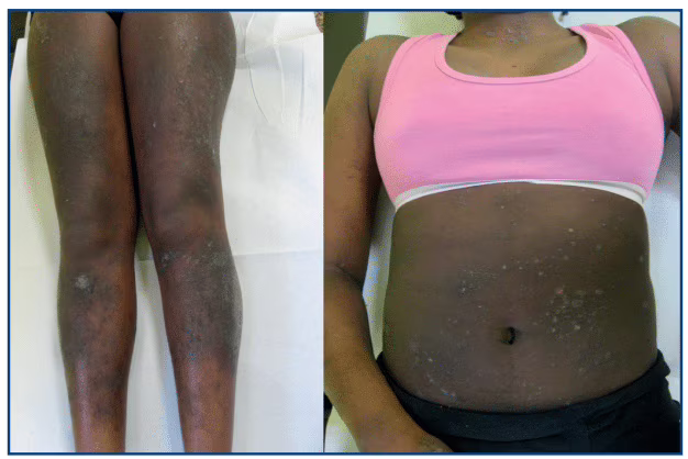 Ragazza di 14 anni affetta da dermatite atopica.