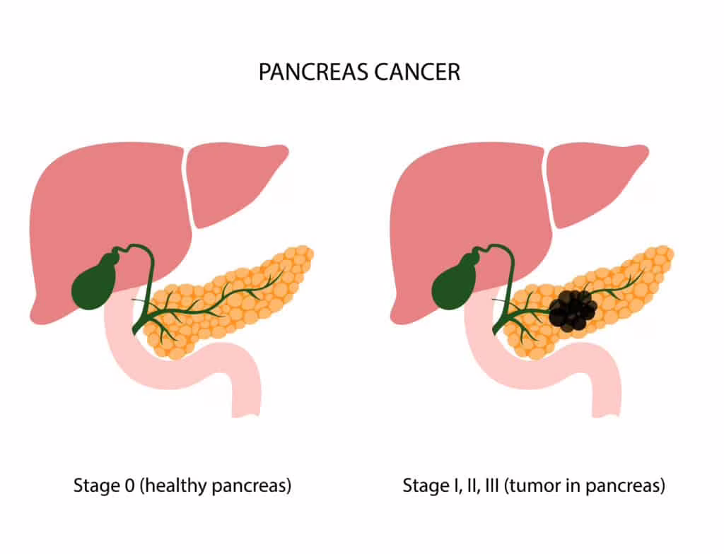 tumore al pancreas